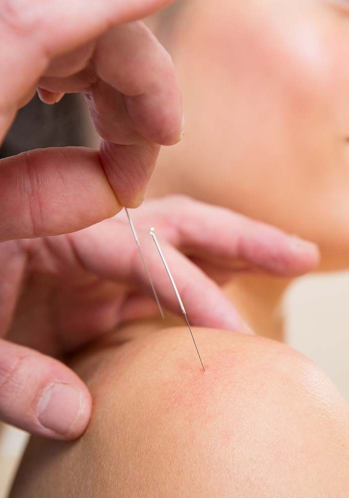 Doctor hands acupuncture needle pricking on woman patient closeup